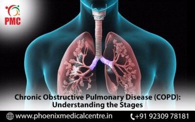 Chronic Obstructive Pulmonary Disease (COPD): Understanding the Stages