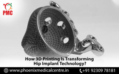How 3D Printing Is Transforming Hip Implant Technology?