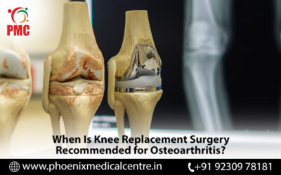 When Is Knee Replacement Surgery Recommended for Osteoarthritis?