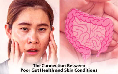 The Connection Between Poor Gut Health and Skin Conditions