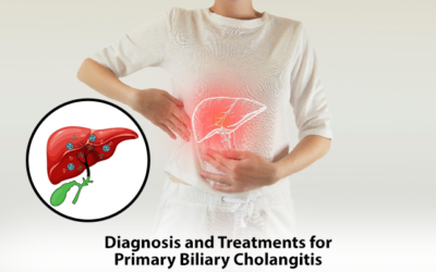 Diagnosis and Treatments for Primary Biliary Cholangitis