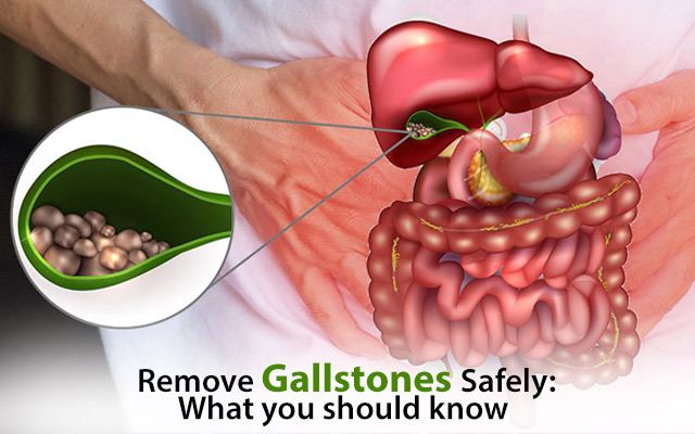 Remove Gallstones Safely: What You Should Know