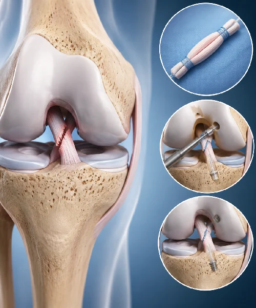 ACL Repair