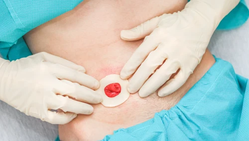 Abscess Drainage