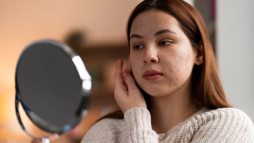 Acne & Acne Scar Treatment