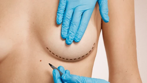 Breast Lump Surgery