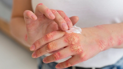 Burn Reconstruction