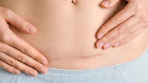 C-Section & Stitch Care C-Section & Stitch Care