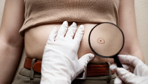 Cyst & Lipoma Removal
