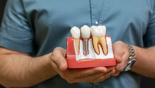 Dental Implant Surgery Support