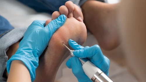 Diabetic Foot Surgery