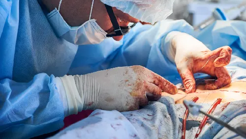Emergency Appendix Surgery Emergency Appendix Surgery