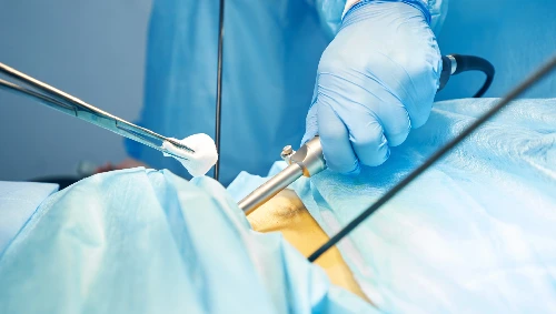 Gallstone Surgery