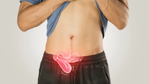 Hernia Surgery