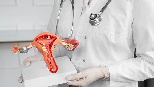 Hysterectomy for Fibroids Hysterectomy for Fibroids