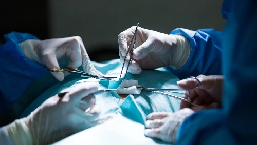 Keyhole Gallstone Surgery