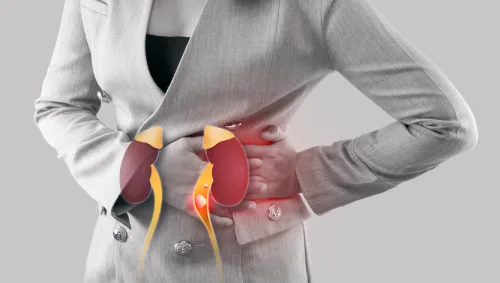 Kidney Stone Management