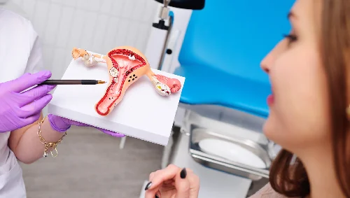 Laparoscopic Assisted Vaginal Hysterectomy Laparoscopic Assisted Vaginal Hysterectomy