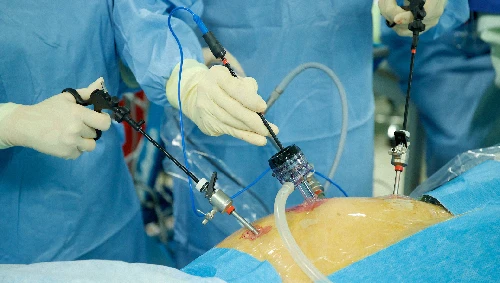 Laparoscopic Gallbladder Removal