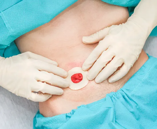 Laparoscopic Hernia Laparoscopic Hernia