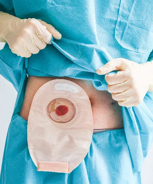 Laparoscopic Hernia Laparoscopic Hernia