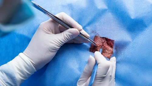 Mesh-Based Hernia Repair Mesh-Based Hernia Repair