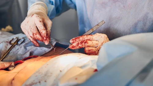 Minimally Invasive Surgery