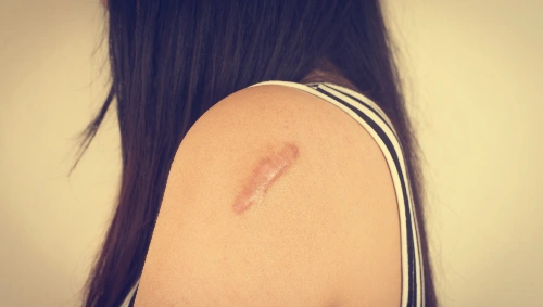 Scar Revision Surgery