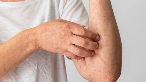 Skin Allergy & Rash Treatment