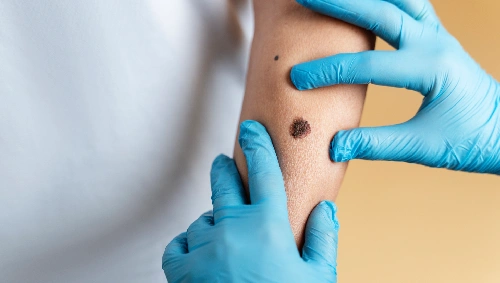 Skin Lesion Removal