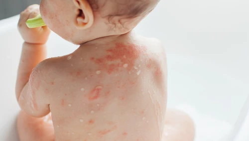 Skin Rashes & Infections