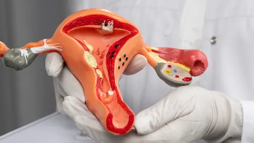Total Laparoscopic Hysterectomy Total Laparoscopic Hysterectomy