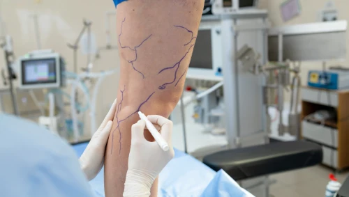 Varicose Vein Surgery