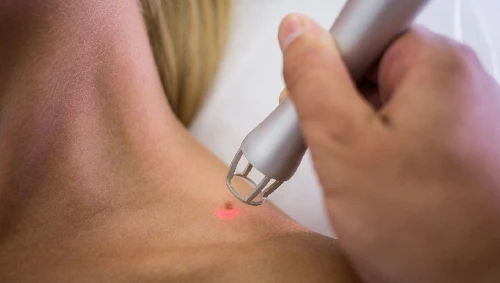 Wart, Mole & Skin Tag Removal