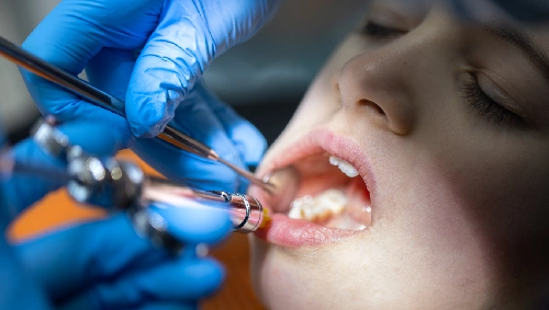 Wisdom Tooth Surgery
