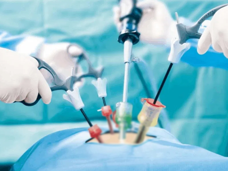 Minimally invasive laparoscopic surgery using small incisions and surgical instruments for faster recovery